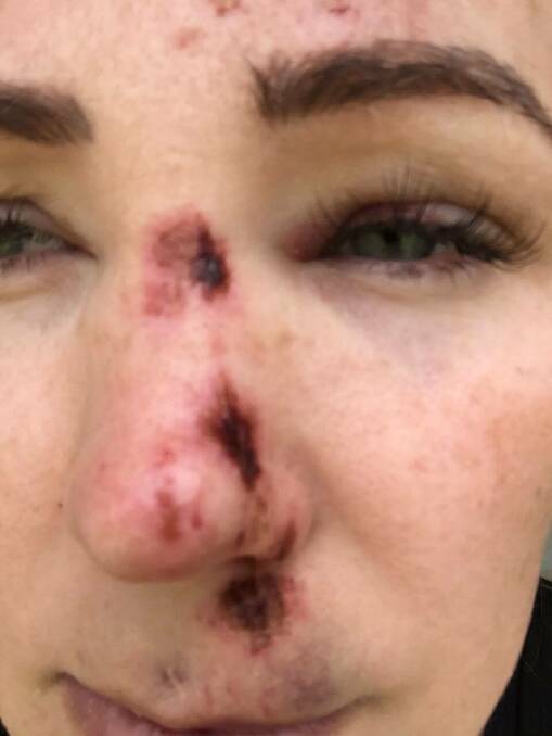Lauren Greene following the alleged assault in the early hours of Christmas Day. 